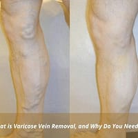 Varicose Vein Removal