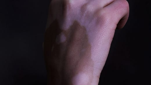 vitiligo